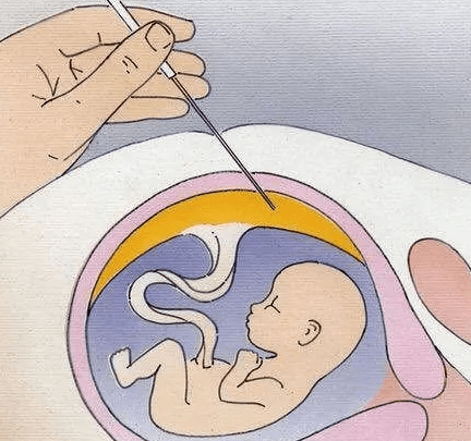 孕妇做羊穿后需要休息3天请公假还是病假？