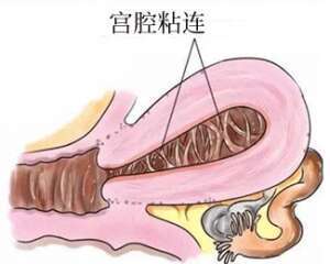  宫腔粘连在绍兴做试管婴儿怎么样？
