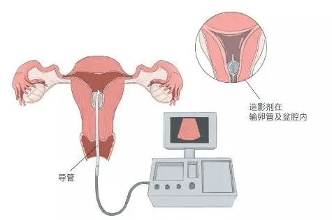 “输卵管远端堵塞”，这是什么情况？