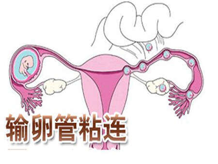 输卵管粘连是一种妇科疾病,致病原因及治疗方法如文章所见