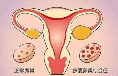 多囊卵巢综合征自然受孕几率大吗?注意调节生活方式可提高受孕几率