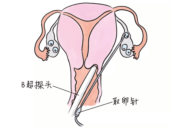 试管打夜针了发烧还能正常取卵吗？