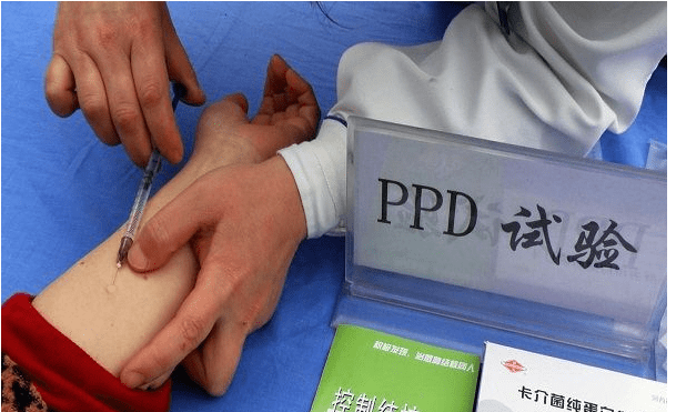 PPD试验
