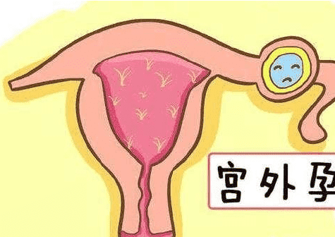 试管移植后的风险，不排除有宫外孕的可能