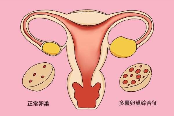 AMH值高不能确定是多囊，要根据实际情况来判断
