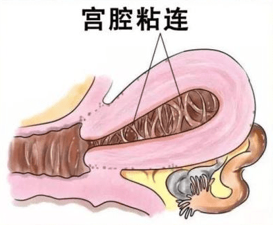 解决子宫粘连:多种治疗方法