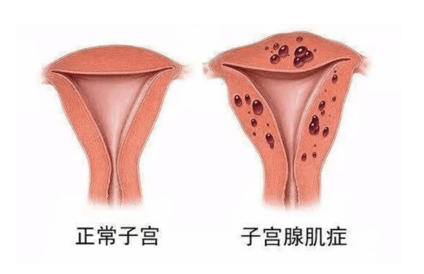 腺肌症吃什么药最好,子宫腺肌症吃什么药可以缓解疼痛