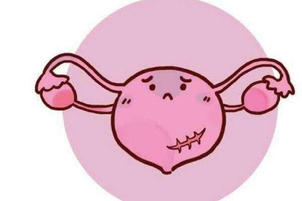 子宫肌瘤是什么原因导致的？要不要做手术？