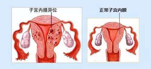 子宫内膜炎怎么治疗?常用的治疗方法有哪些呢?