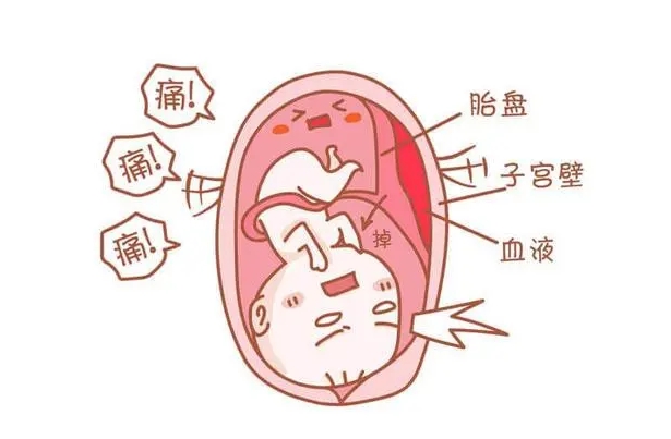 胎膜早破：试管婴儿之路面临挑战