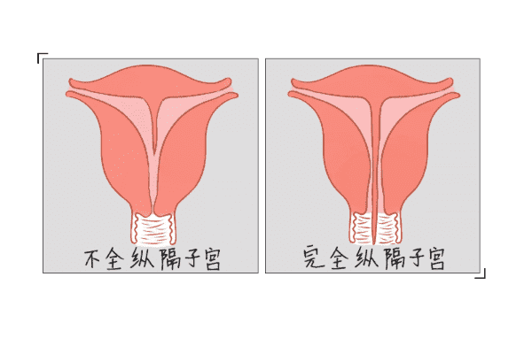女性有不完全纵隔子宫可以顺利生产吗？