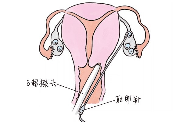 试管单腔和双腔取卵针的区别是什么，适合哪种方式根据情况而定