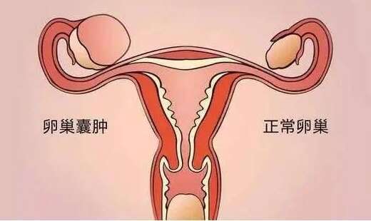 卵巢囊肿做试管必须穿刺吗?囊肿穿刺的要求