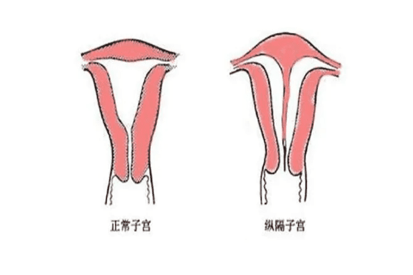 不完全纵隔子宫要做手术吗？哪些情况要做手术？