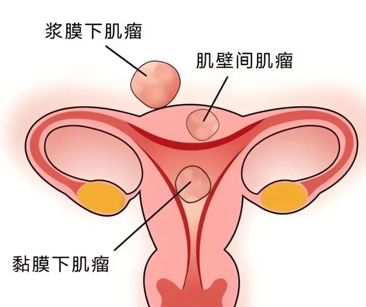 子宫肌瘤还能不能做试管婴儿？