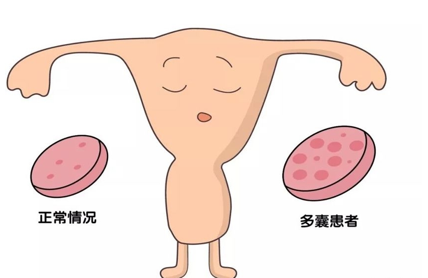 多囊卵巢做试管婴儿的成功率高吗？移植成功后的表现有哪些？
