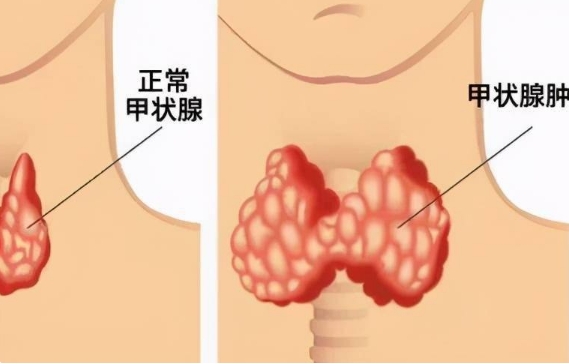 甲状腺左侧囊肿影响试管婴儿吗?	
