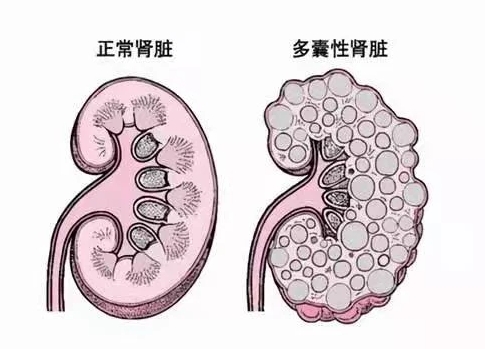 三代试管pgd可以筛除多囊肾降调遗传几率?	