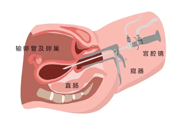 宫腔镜后一个月怀孕了怎么办？孩子能不能要？	