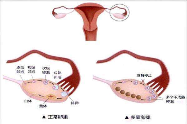 多囊卵巢综合征在哈尔滨做试管好吗？