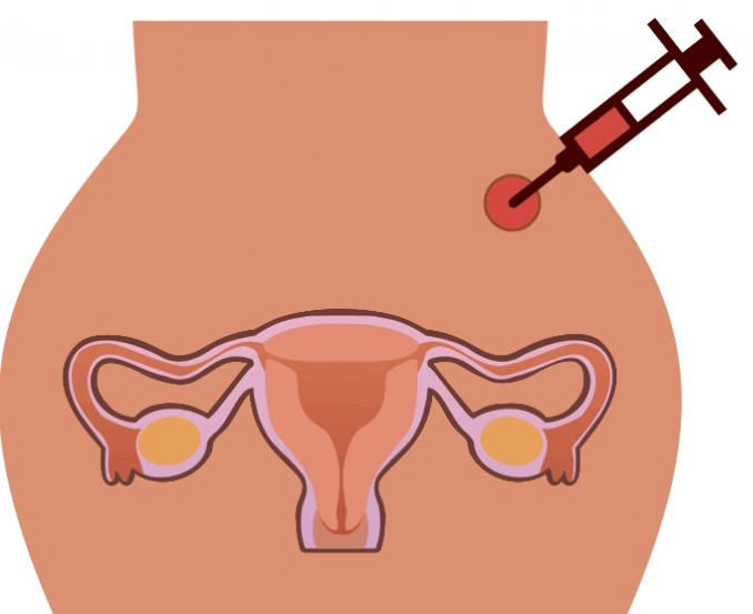 绝经女性试管之路：六大步骤全解析