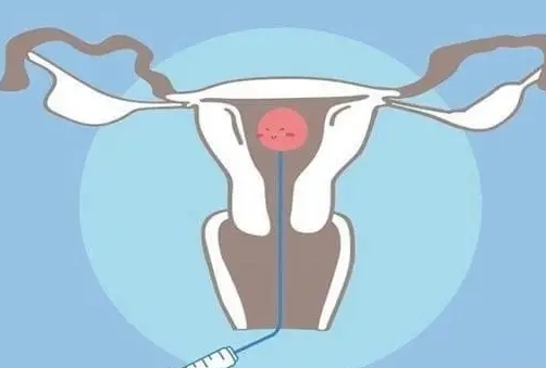 单身女性的试管育儿之路，可行吗？