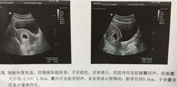子宫息肉可以去泰国做试管吗？大概需要花费多少钱