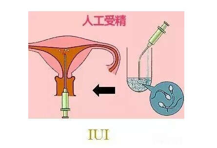 上海集爱做第三代试管婴儿成功率怎么样？高不高？