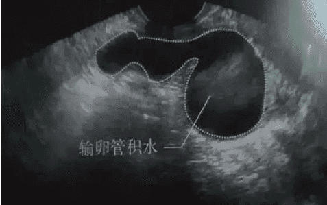 2025正规医院人工受孕费用公开，人授和试管价格差距不止千元
