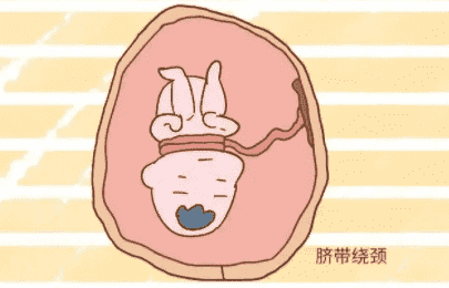 多囊卵巢综合征严重吗？饮食有什么忌口的？