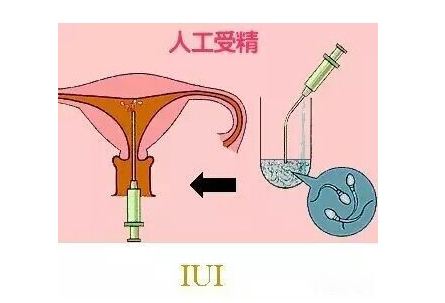 单身未婚没有结婚证怎么做试管？国外生殖助孕生出健康宝宝